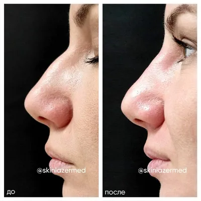 Контурная пластика носа Инъекционная ринопластика SkinLazerMed