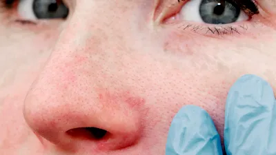 Безоперационная ринопластика, коррекция носа филлерами в СПб - цена  контурной пластики носа