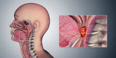 Рак (опухоль) носоглотки - симптомы, причины, диагностика и лечение в  лучших клиниках