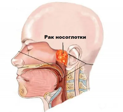 Рак носоглотки: симптоматика, лечение