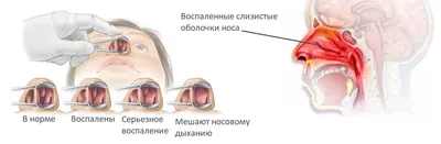 Степени аденоидов