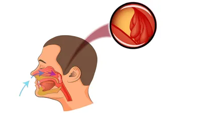 Воспаление носоглотки: симптомы, причины появления боли, методы лечения