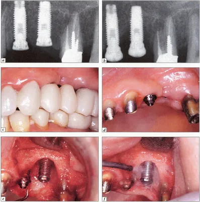 ТОП 7 причин отторжения зубных имплантов при имплантации!