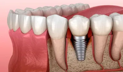 Периимплантит, цена лечения в Москве