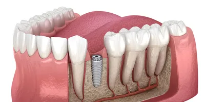 Отторжение импланта - причины, симптомы, профилактика, повторная имплантация