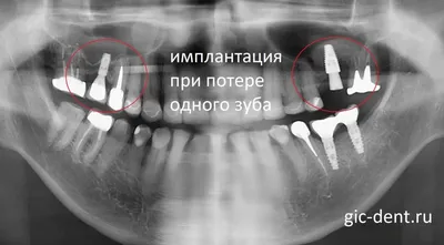 Имплантация зубов в Королёве: цены от 11000 рублей, виды имплантов