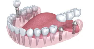 Имплантация зубов в Киеве – Стоимость и отзывы ᐈ Certus | Certus