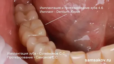 Одноэтапная имплантация зубов - выбор метода восстановления зубов