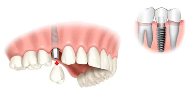 Осложнение после имплантации - установка зубных имплантов