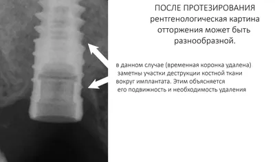 Имплантация зубов в Краснодаре: установка, типы, преимущества, отзывы, цены  - Стоматология доктора Айрумова «32 Clinic»