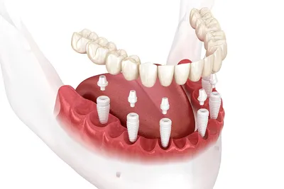 Имплантация зубов в Клину — Стоимость имплантов зубов в МЦ Надежда