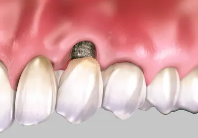 Осложнения после имплантации зубов ТОП1 клиника Москвы - Немецкий  имплантологический центр
