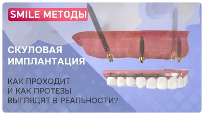 Имплантация зубов в Киеве – Стоимость и отзывы ᐈ Certus | Certus