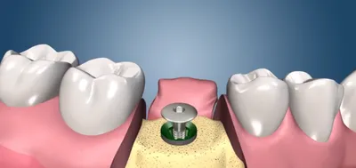 Имплантация зубов цены под ключ, зубные импланты в Москве