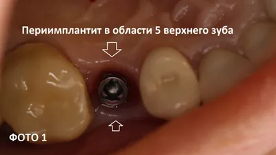 Как распознать и предотвратить отторжение импланта