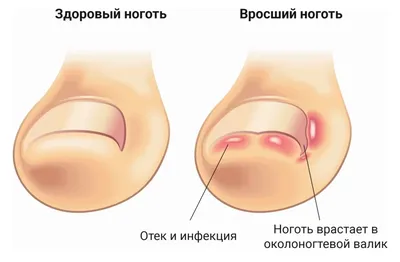 Методы лечения онихокриптоза (вросшего ногтя) у детей ✓ Авторские статьи  Клиники Подологии