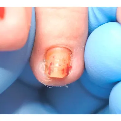 Протезирование ногтей в СПб, восстановление ногтевой пластины | клиника  «Ева»