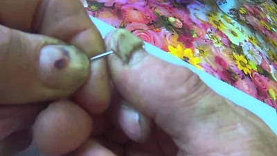 Удаление вросшего ногтя ᐉ Цена хирургического лечения вросшего ногтя в  Полтаве • Отзывы пациентов из Киева и Харькова