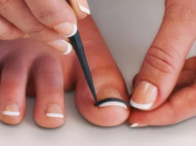 Восстановление ногтевой пластины после резекции | Московская Клиника  Подологии