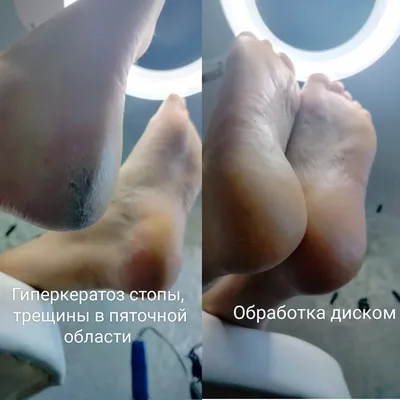 СМАРТ ПЕДИКЮР | SiaNails | Дзен