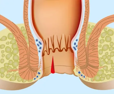 Во время полового акта и после появляется боль в заднем проходе
