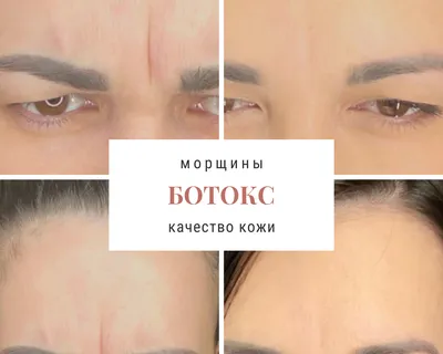 Диспорт в Сочи. Врачи дерматологи-косметологи в клинике Идеалиста