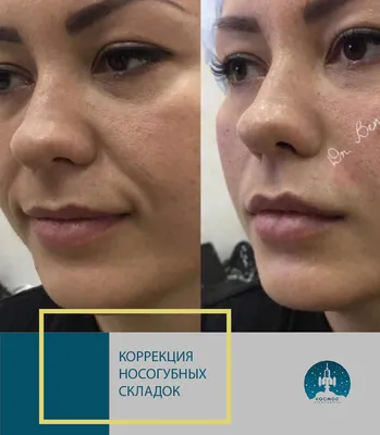 Ботокс инъекции - ботулинотерапия в Иваново | Прием врача косметолога