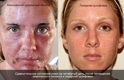 Пилинг для лица: цена от 4990 рублей в Москве | Стоимость пилинга PRX-T33 в  клинике BeautyWay Clinic