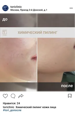 Пилинги для лица