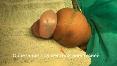 Младенцу чудом спасли половой орган после обрезания