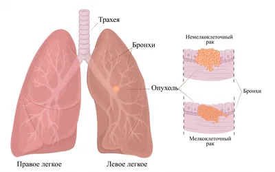 Пересадка легких: Директор Института Шалимова Усенко: \"К операции по  пересадке легких мы готовились семь месяцев\". Эксклюзивный ФОТОрепортаж «  Новости | Мобильная версия | Цензор.НЕТ