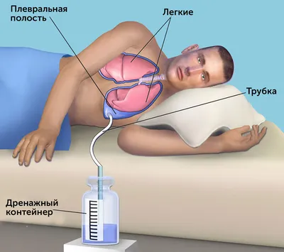 Thoracoscopic surgery