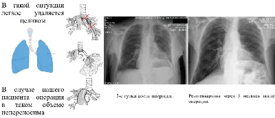 Персонифицированный подход в хирургическом лечении злокачественных опухолей  легких