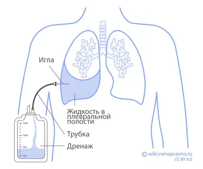 Врачи Ростовского НМИЦ онкологии применили новый подход для лечения рака  лёгкого