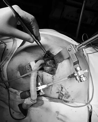 Как малоинвазивная хирургия сердца спасает жизни и сокращает время  восстановления | Кардиохирург Нургалиев Рахим Ринатович | Дзен