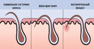 depilation_ot_anastacia - После профессионального шугаринга синяки не  остаются❗ Основными причинами появления синяков является ❌ошибки в технике  выполнения процедуры мастером и неверно подобрана консистенция сахарной  пасты. ➡️Частой причиной также ...