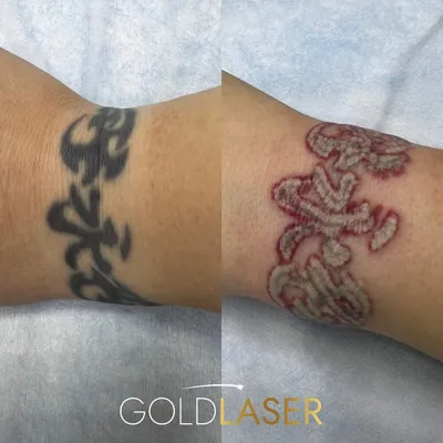 Лазерное удаление татуажа и татуировок в Киеве - удалить тату по цене в  Goldlaser