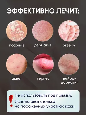 Лечение псориаза, экземы, атопического дерматита, наработанные протоколы  лечения — Многопрофильная клиника Н.Березиной Ульяновск