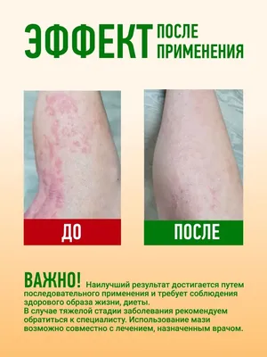 Диагноз кожных заболеваний - аллергий, псориаза, Eczema, дерматита  Дерматолог с перчатками рассматривает кожу больного Стоковое Изображение -  изображение насчитывающей доктор, экзема: 154129127