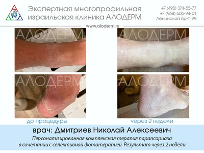 Лечение псориаза (чешуйчатого лишая) в Киеве — Derma.ua