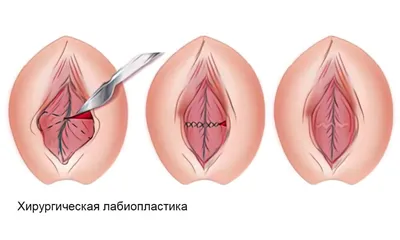 Омоложение половых губ филлерами - GK Klinika