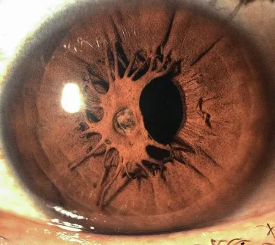 Радужка глаза: функции, строение, болезни и лечение