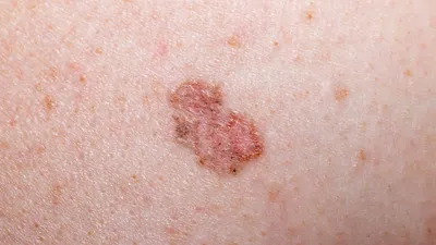 Быть здоровым — здорово»: как предотвратить рак кожи - YouTube