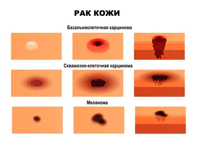 Базалиома (базальноклеточный рак кожи): симптомы, стадии, прогнозы,  классификация, методы диагностики и лечения