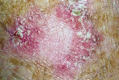 Спросите эксперта: остановить рак до того, как он начнется - Фонд рака кожи