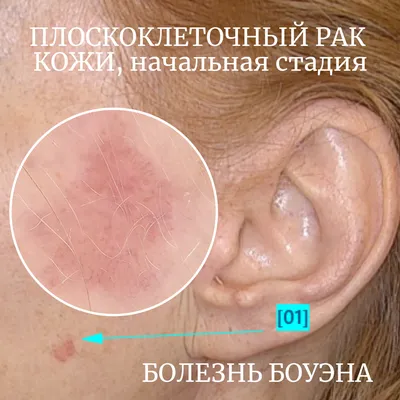 Плоскоклеточный рак кожи, самая начальная стадия. Болезнь Боуэна. |  dr.dzhunkovskaya | Дзен