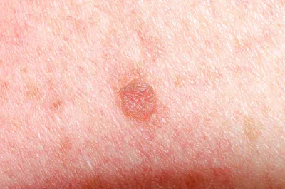 Рак кожи: симптомы, как выглядит, признаки, стадии, лечение