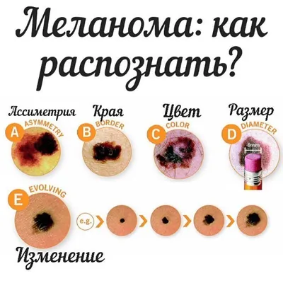 Меланома: симптомы, стадии, классификация, прогноз, вероятность, признаки