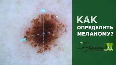 Меланома кожи: диагностика и лечение в Минске