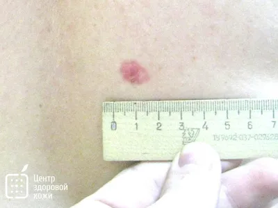 Рак кожи: плоскоклеточный, базальноклеточный, меланома - диагностика и  лечение в Москве